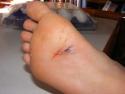 Carolyne's foot: deep cut from clamshell on beach
